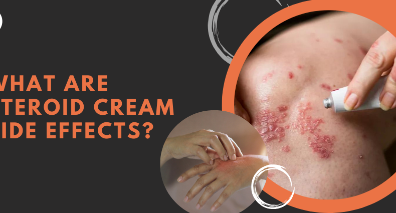 What are steroid cream side effects