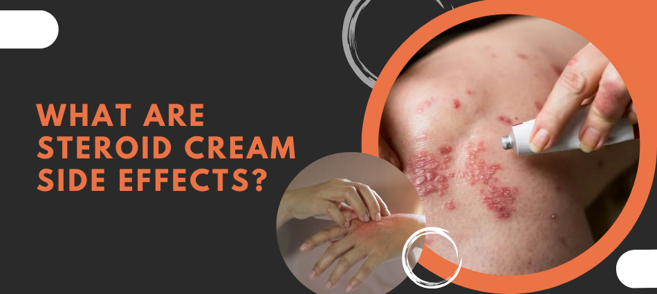 What are steroid cream side effects